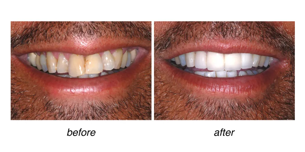 before and after of teeth whitening