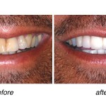 before and after of teeth whitening