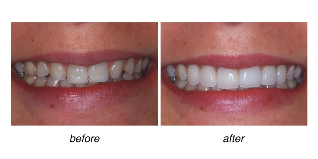 before and after of teeth whitening