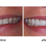 before and after of teeth whitening