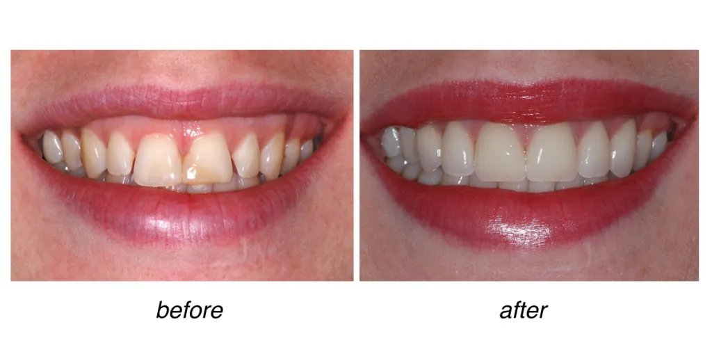 before and after of teeth whitening