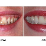 before and after of teeth whitening