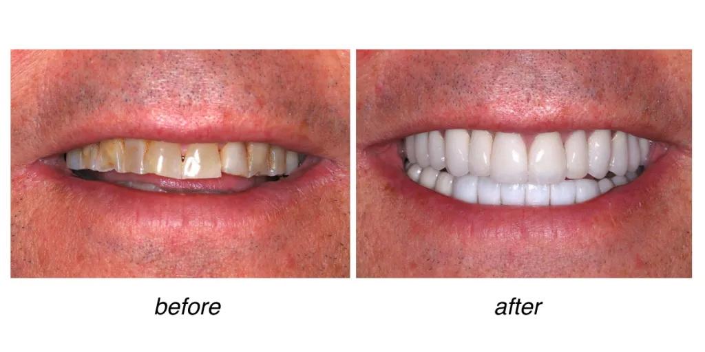 before and after of teeth whitening