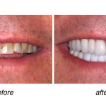 before and after of teeth whitening