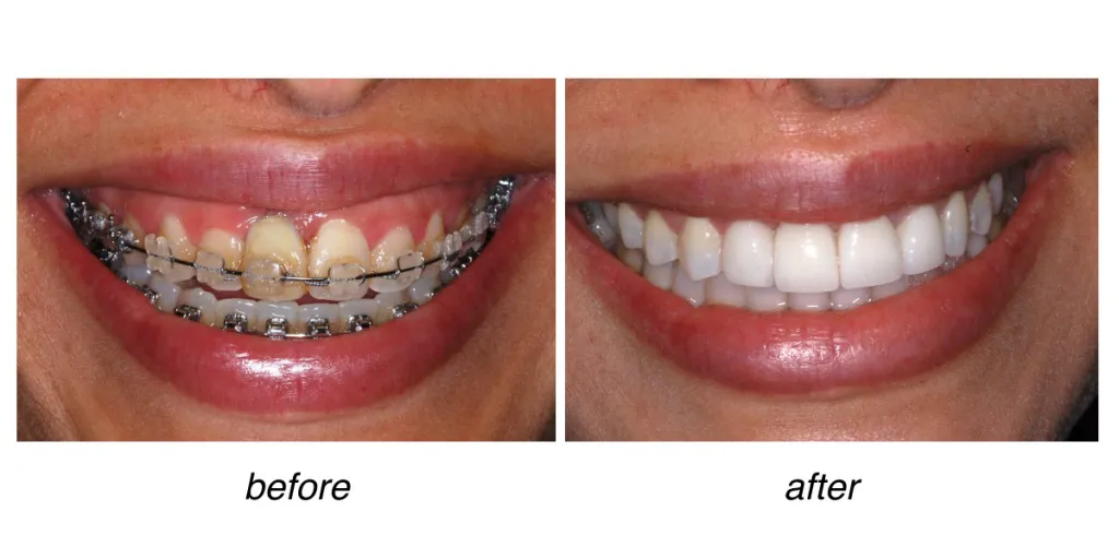 before and after of teeth whitening