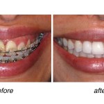 before and after of teeth whitening