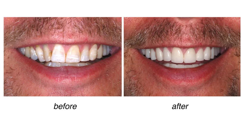 before and after of teeth whitening