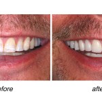 before and after of teeth whitening
