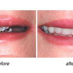 before and after of teeth whitening