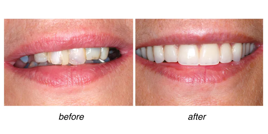 before and after of teeth whitening