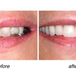 before and after of teeth whitening