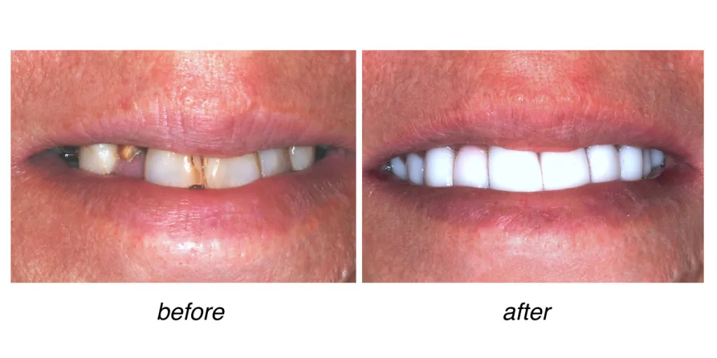 before and after of teeth whitening