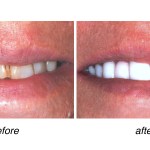 before and after of teeth whitening