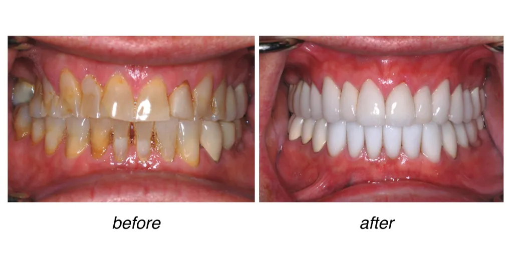 before and after of teeth whitening