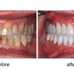 before and after of teeth whitening