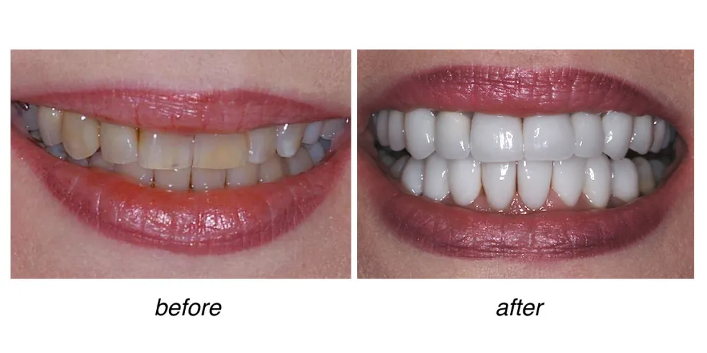 before and after of teeth whitening