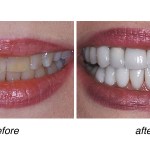before and after of teeth whitening