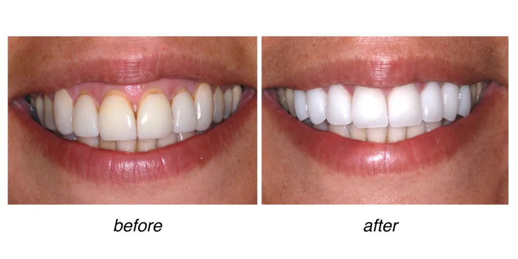 before and after of teeth whitening