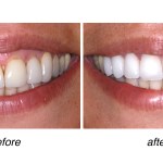 before and after of teeth whitening