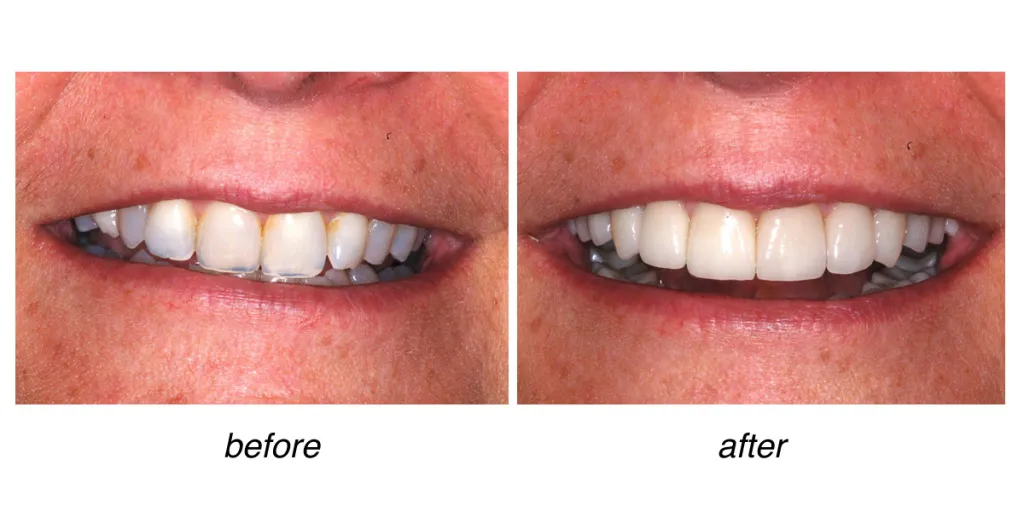 before and after of teeth whitening