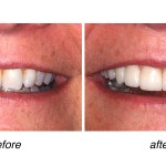 before and after of teeth whitening